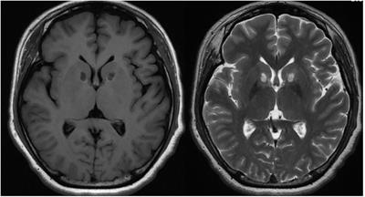 Magnetic Resonance-Guided Focused Ultrasound Surgery for Obsessive-Compulsive Disorders: Potential for use as a Novel Ablative Surgical Technique